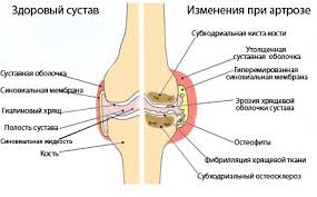 артрит локтевого фото