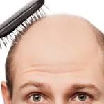  Researchers say experimental drug could lead to treatment for baldness