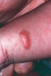 Image result for mastocytosis