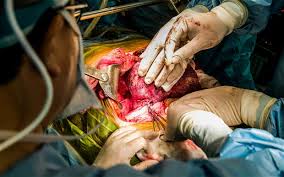 Image result for images of human organ for transplant