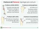 Frattura del femore riabilitazione