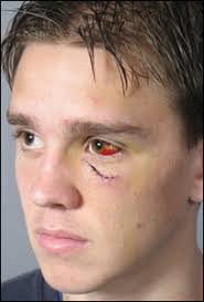 Stuart Holden. Mr Holden&#39;s eye socket was fractured in three places - _40954547_stuartholden_300