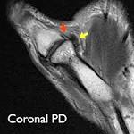 Stener lesion mri