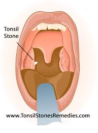 Image result for tonsil stones
