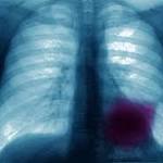  Lung Cancer Rates Are Higher in Women Than Men for the First Time Ever. Scientists Don't Know Why