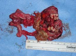 Image result for teratoma