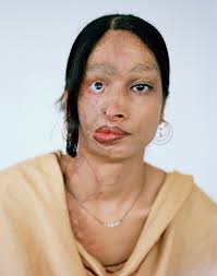 Image result for acid attack