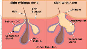 Image result for acne