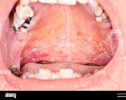 Image of Oral thrush on the roof of the mouth