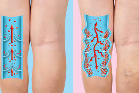 Má circulação sanguínea: como se manifesta | Clinicas Persona