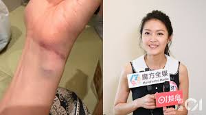 陳庭欣拍打戲意外重摔全身跌傷 大腿臀部手腕大面積瘀青傷勢驚人