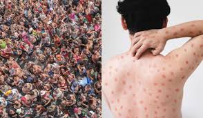 Porto Alegre confirma 1º caso de mpox em 2026 e faz alerta no Carnaval: ‘Evitar contato’