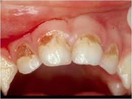 Resultado de imagen de bebe con caries