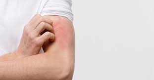 Prurito cronico: dalla sottovalutazione alla medicina personalizzata con nuovi esami ematici