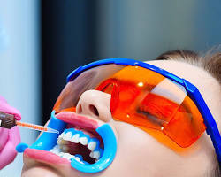 Image of inoffice teeth whitening