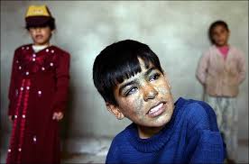 Ayad Bressem, an Iraqi boy, with family members. He said an American bomb blinded him in one eye. - 17casu_slide1