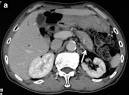 Autoimmunpankreatitis - Facharztwissen