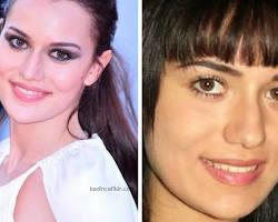 Fahriye Evcen estetiksiz ve estetikli hali resmi