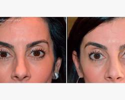 Dermal fillers for temples