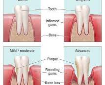 Image of Gum disease