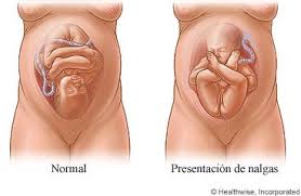 Resultado de imagen para atencion de parto pelvico 