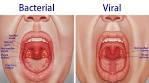 Viral tonsillitis contagious