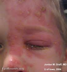 Image result for "Herpes Zoster"