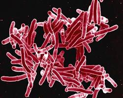 Image of tuberculosis microscopic images