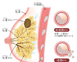 乳がん検診 人間ドックの画像