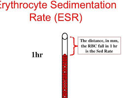 Image of ESR blood test procedure diagram