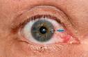 Herpes im Auge (Augenherpes) Symptome und Behandlung