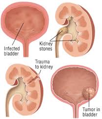 Image result for hematuria