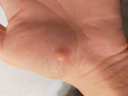 Nổi cục u hạt cơm ở lòng bàn tay, liệu có nguy hiểm?