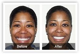 Mrs. Debby Johnson is from South Africa, she had Extreme gummy smile corrected by crown lengthening surgery and 8 porcelain veneers by Dr. Ruchir Garg. - pic-gums2