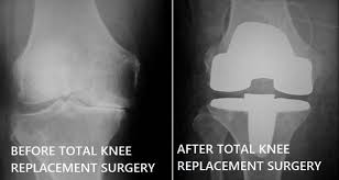 Image result for knee replacement before and after