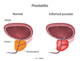 Image result for Melatonin Could Reduce Risk of Prostate Cancer