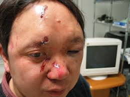 Dr. Li Yuan with 15 stitches for the wounds on his face after being beaten by gunmen in his own home on Feb. 8. The CCP agents covered him with a bed quilt ... - liyuan-01