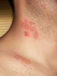 Herpes Zoster Picture Image on m