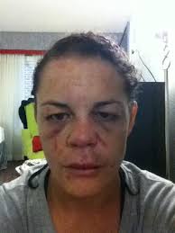 &quot;Who needs to pay for Botox when you can have @criscyborg puff up your lips ;)&quot; -Fiona Muxlow &middot; Bhk8v_yceaevy8k_medium. &quot;Hanging out with my friend Alex&quot; ... - BHK8V_YCEAEvy8k