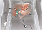 Ablation de la vesicule biliaire par coelioscopie