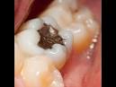 Carie dentaire : prvention, diagnostic et traitement - m