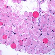 Capricor Cell Therapy Shows Promise in Duchenne Muscular Dystrophy Treatment