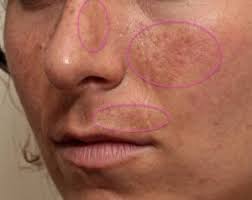 نتیجه تصویری برای لیزر IPL برای لکه های قهوه ای پوست