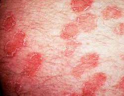 Image result for "ringworm in cattle"