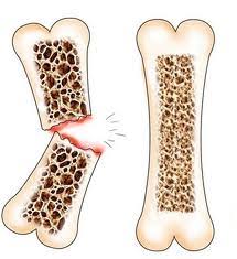 Image result for osteoporosis