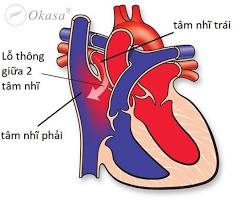 Image of 2 tâm nhĩ và 2 tâm thất của tim