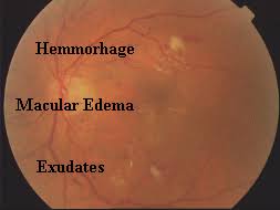 Image result for retinopathy DM