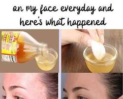 Image of Apple Cider Vinegar Toner for Skin