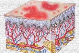 Resultado de imagen para dermatitis sintomas