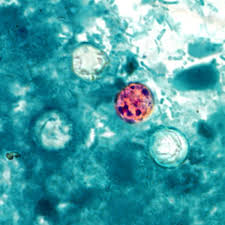 Dozens hospitalized with cyclosporiasis as cases of gastrointestinal illness spike in 31 states